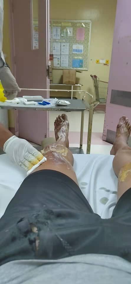 东:双溪兰路提升工程迟迟未竣工,摩托车骑士翻覆受重伤