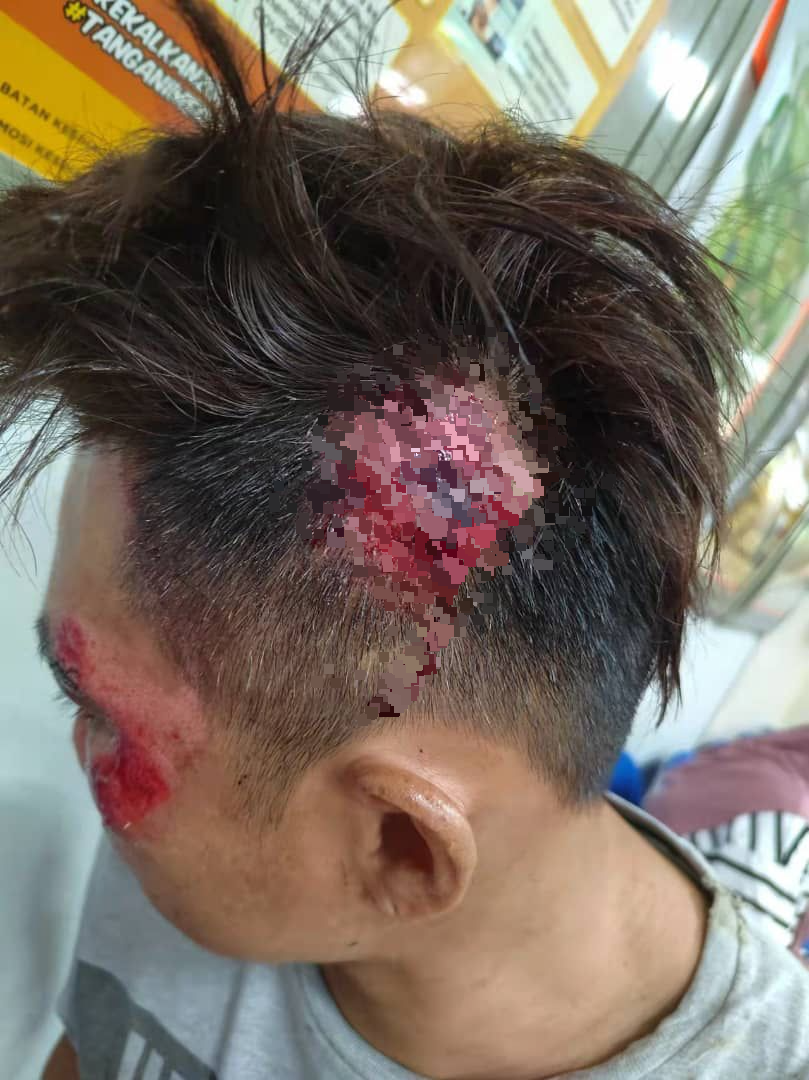 东:双溪兰路提升工程迟迟未竣工,摩托车骑士翻覆受重伤