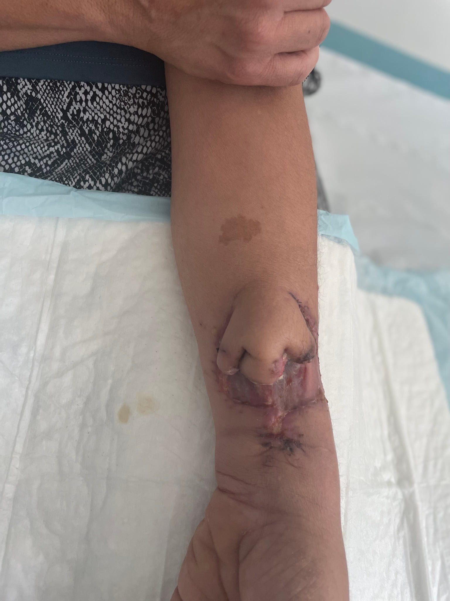 女子9年前患癌失鼻子 医院3D打印+皮肤移植重建鼻子