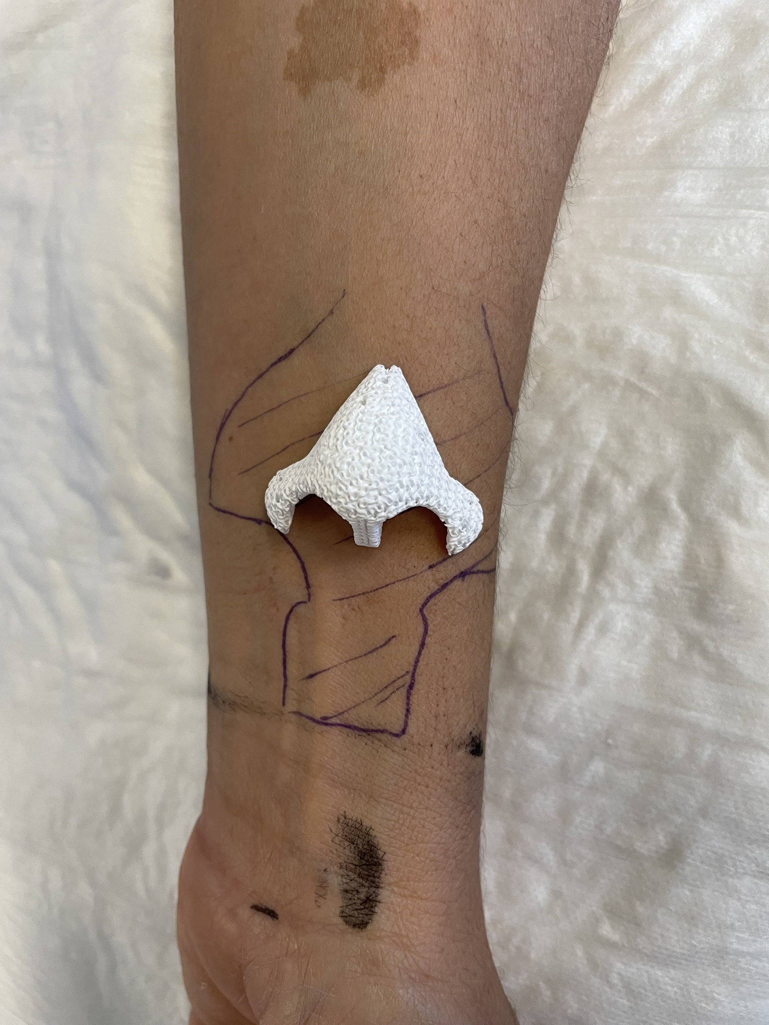 女子9年前患癌失鼻子 医院3D打印+皮肤移植重建鼻子