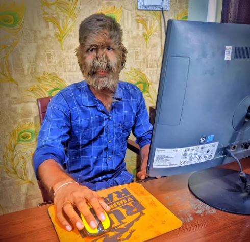  无视旁人歧视欺凌　狼人症少年活在当下