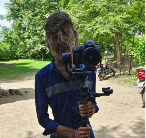  无视旁人歧视欺凌　狼人症少年活在当下