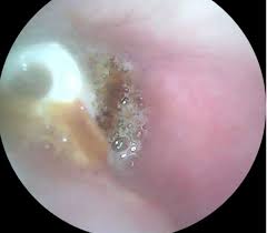 拼盘／他搭飞机后近乎失聪！　5年后才知耳塞掉进耳道