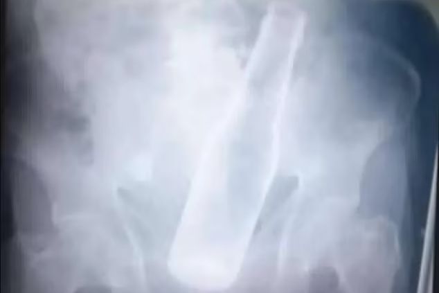 拼盘／整个啤酒瓶“卡屁股里”！　79岁男爆痛就医喊：强盗硬塞的