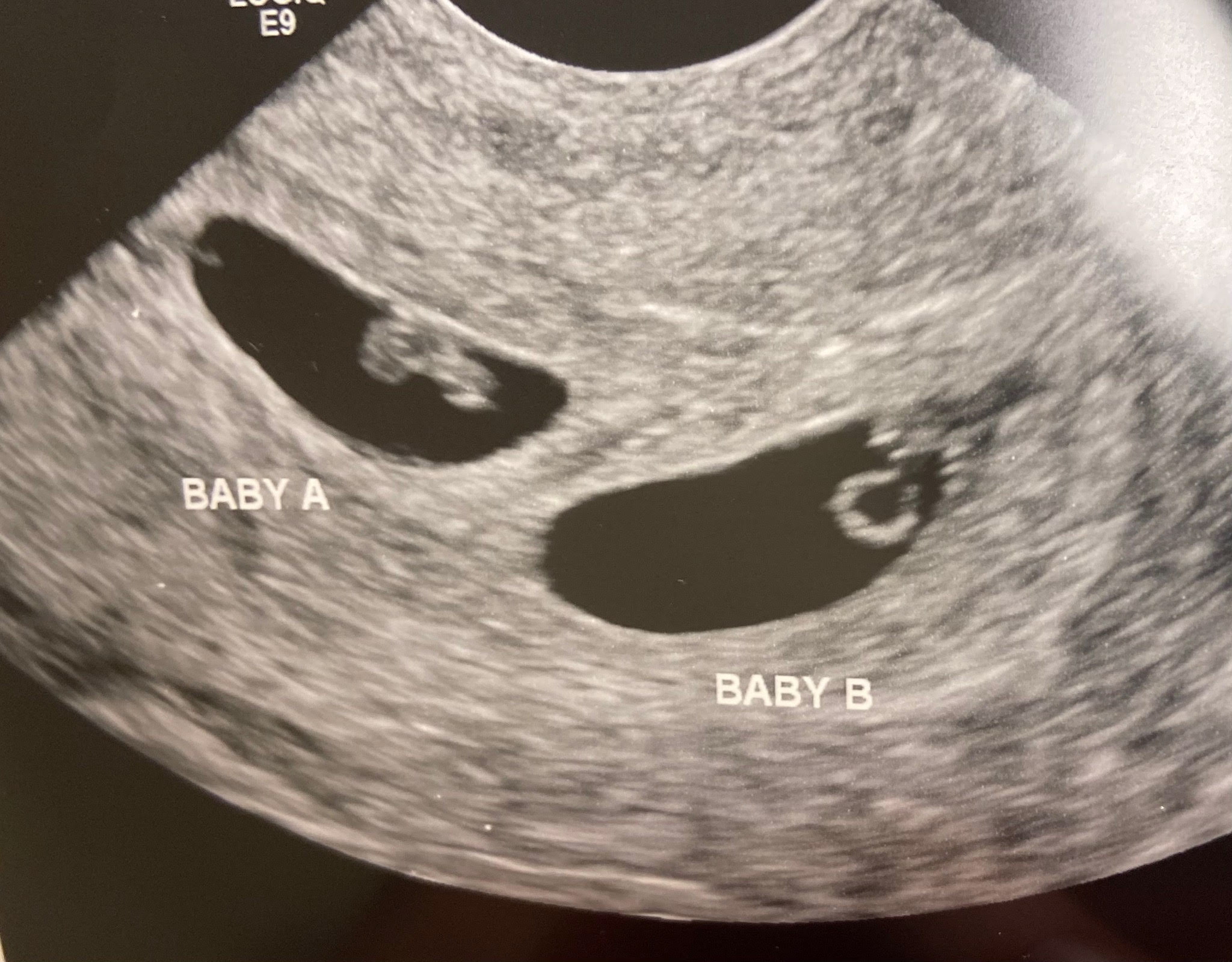 拼盘/美国夫妇植入冷冻了30年胚胎诞龙凤胎 创最长冷藏时间记录