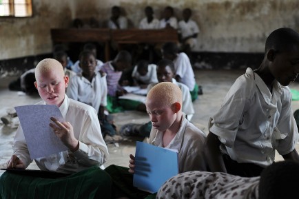 看世界/坦桑尼亚白化症者频遇袭 归因迷信肢体可行秘术