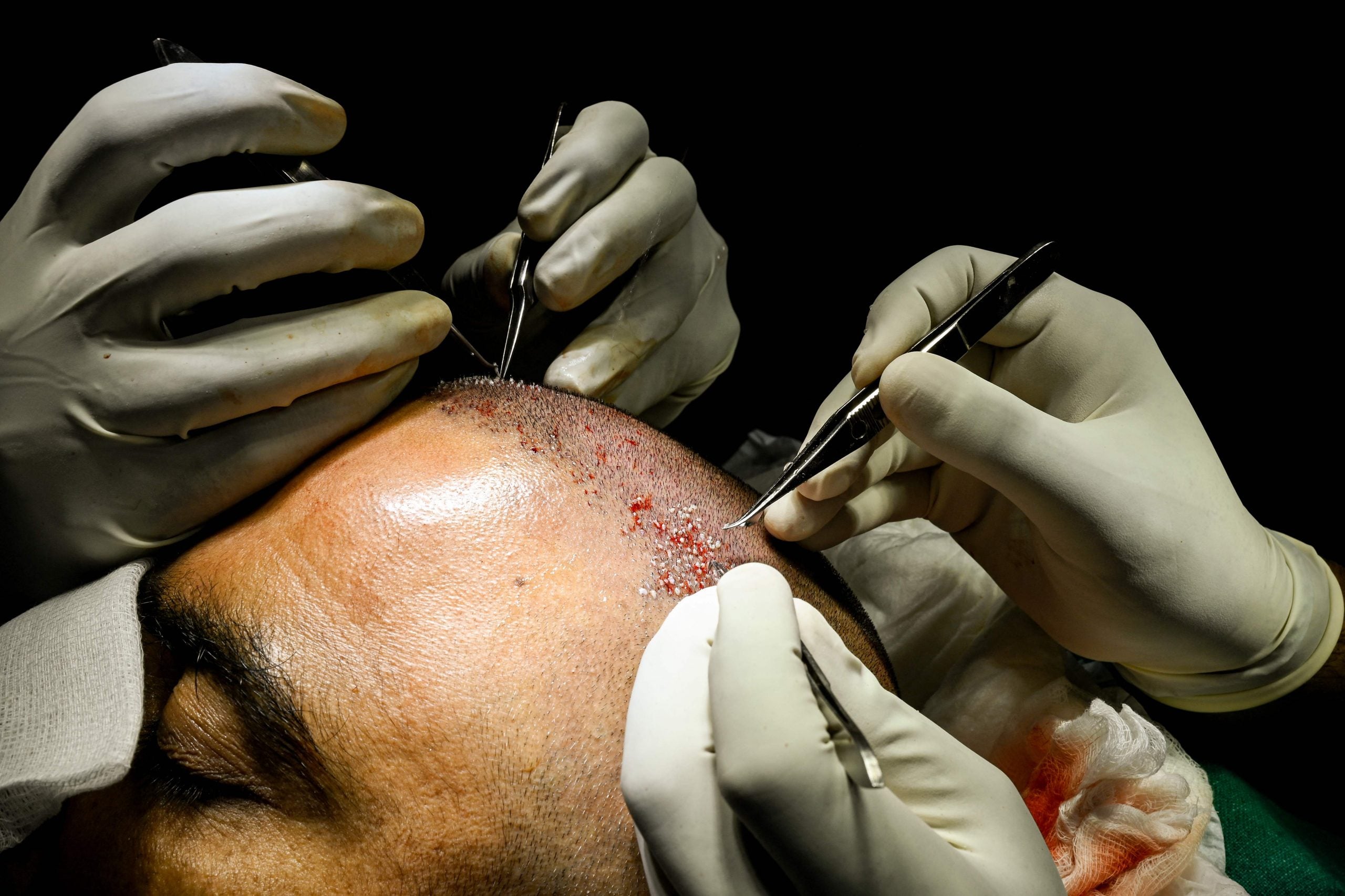 30岁秃头男想脱单 光顾廉价植发惨死  母亲：儿子全身肿胀冒黑疹