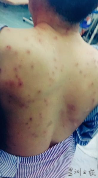供FB／老人爬山保护蜂螫妇女 反被螫逾200针