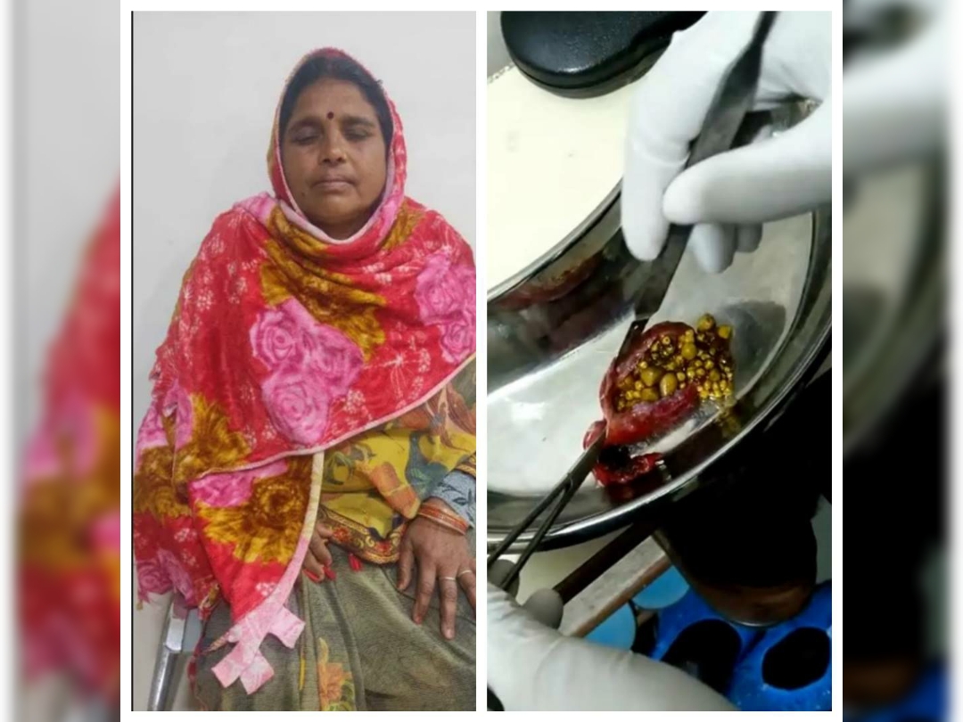 妇女背痛数月就医 胆囊竟有382颗结石