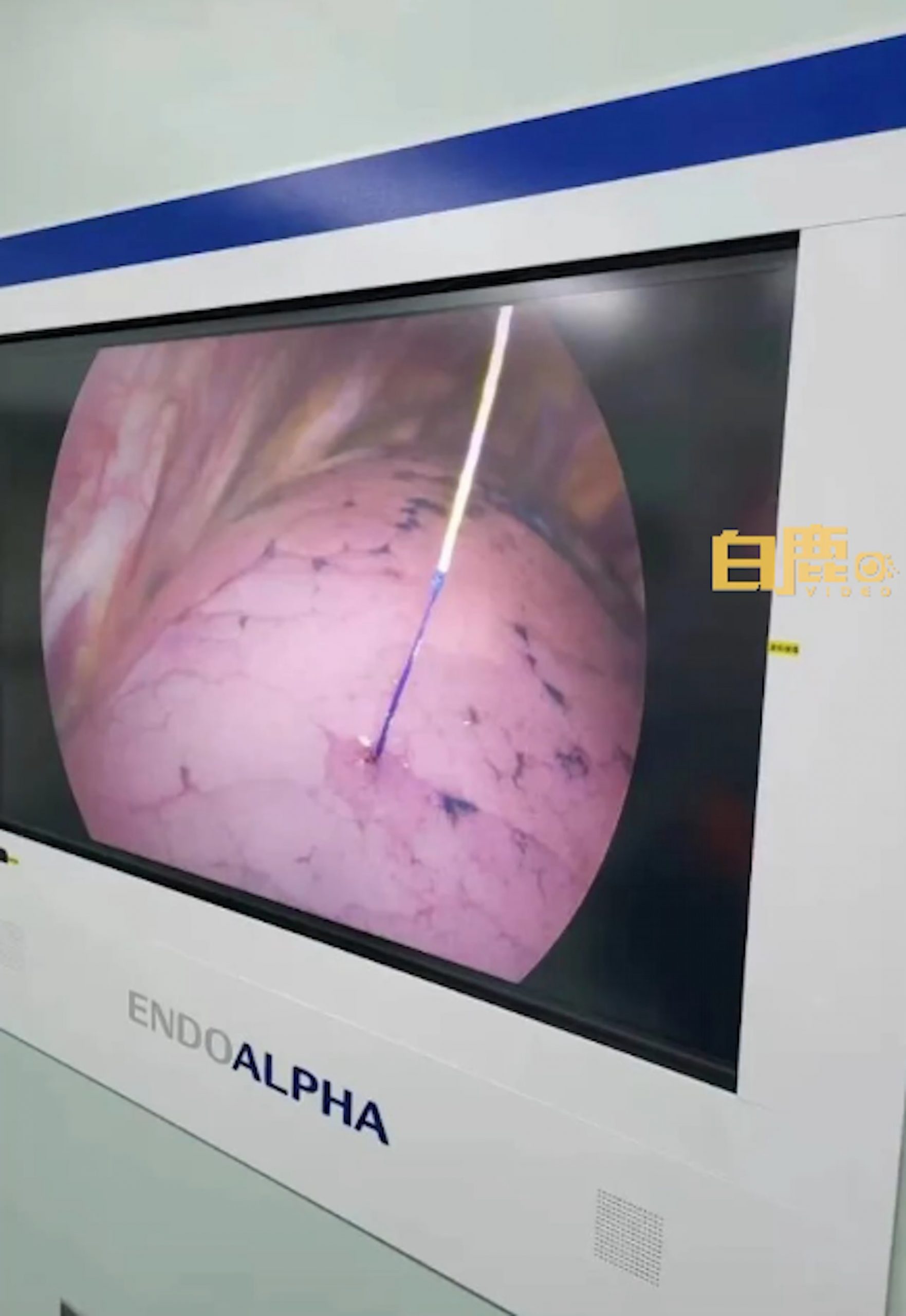 拚图)陕西男胸痛逾月竟发现肺部被刺银针