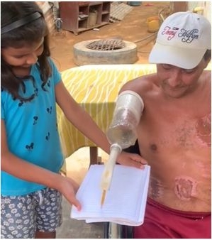 拼盘/以“塑胶瓶”当义肢 男子误触高压电线失去手脚 乐观面对积极复健