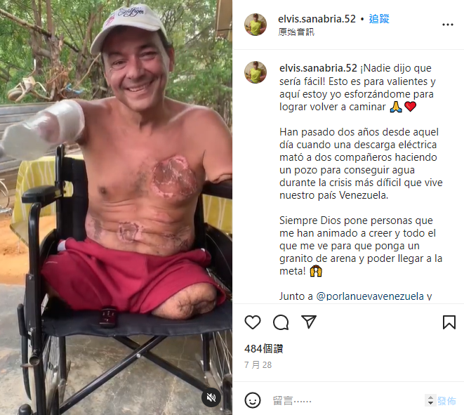 拼盘/以“塑胶瓶”当义肢 男子误触高压电线失去手脚 乐观面对积极复健