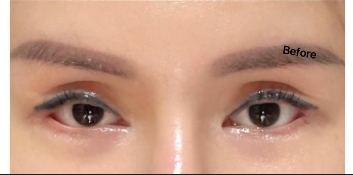 独家|无牌医美割双眼皮付RM6000 女子:“5次手术才修复!”