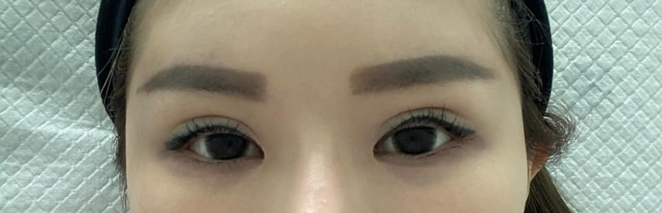 独家|无牌医美割双眼皮付RM6000 女子:“5次手术才修复!”