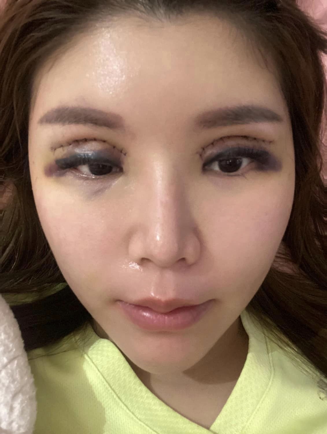 独家|无牌医美割双眼皮付RM6000 女子:“5次手术才修复!”