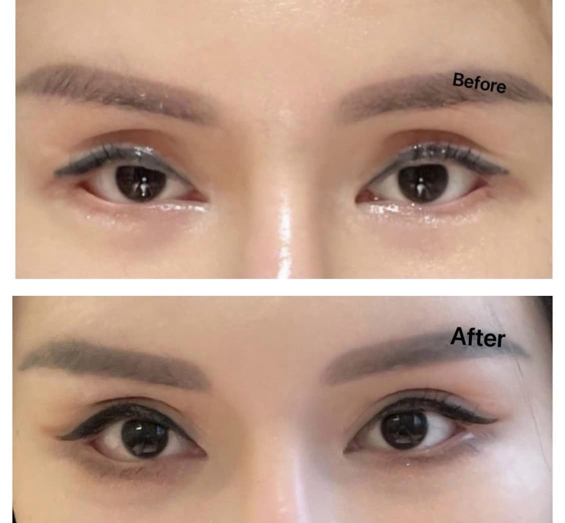 独家|无牌医美割双眼皮付RM6000 女子:“5次手术才修复!”