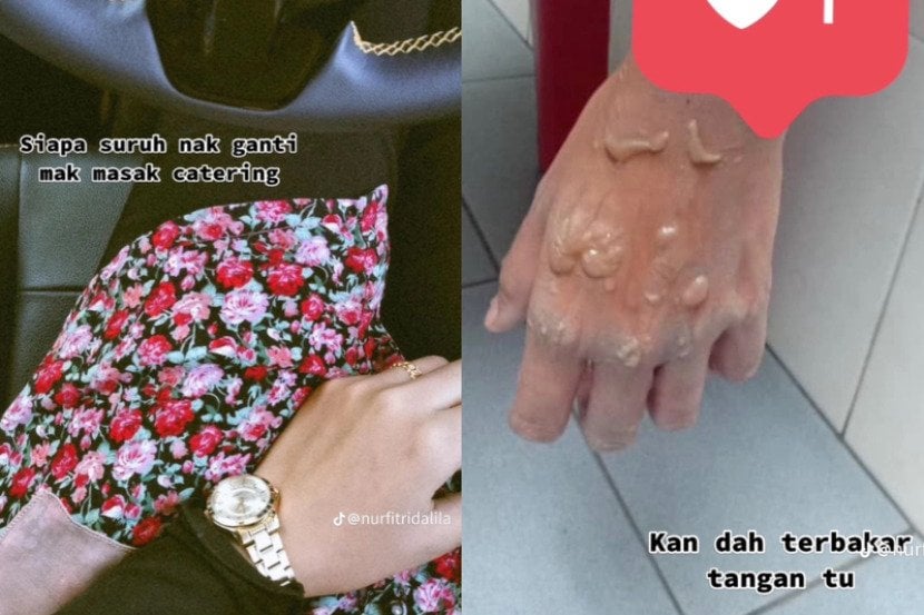 用打火机点燃灶炉出事 女主厨手背灼伤留阴影