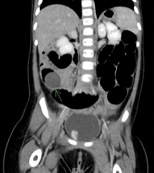 男童误吞水晶宝宝 体内狂胀肠险挤破