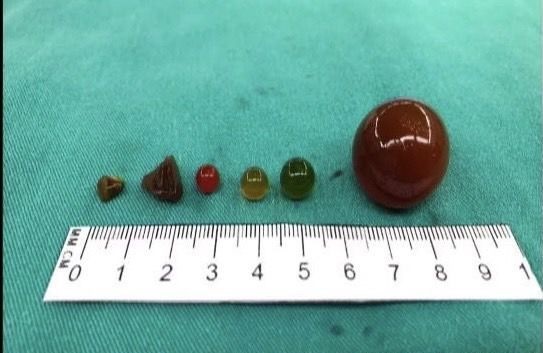 男童误吞水晶宝宝 体内狂胀肠险挤破