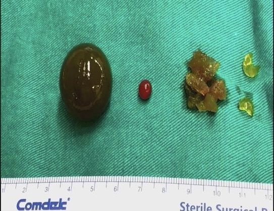 男童误吞水晶宝宝 体内狂胀肠险挤破