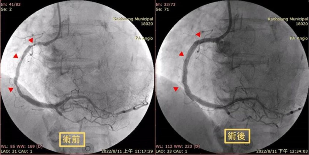 胸口闷痛误认感冒 竟是严重急性心肌梗塞