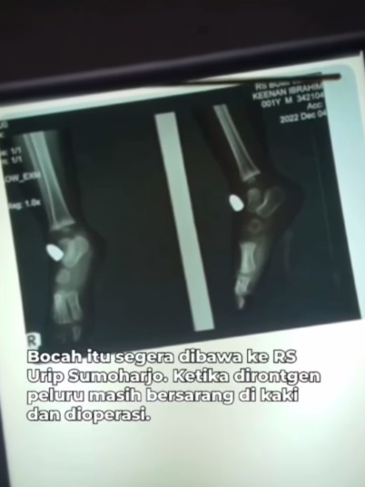 视频|与父母在家睡觉出事 岁半男童被流弹击中