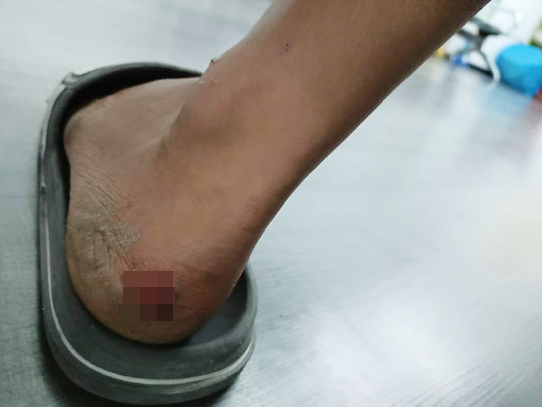 邻居家犬咬伤男童，童父：邻居付20令吉打发