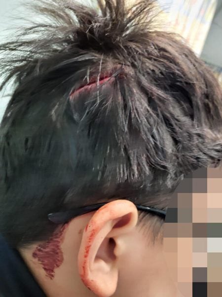 妇女申诉:10岁儿搭双层巴士 失衡滚下梯跌破头