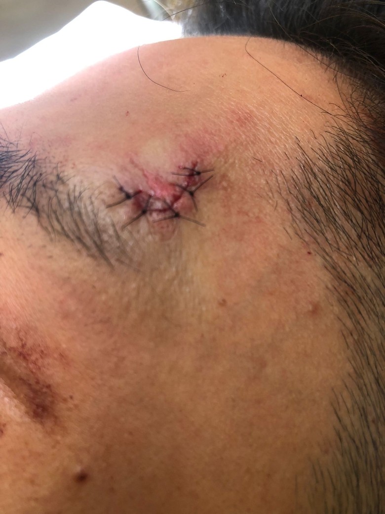 ​拍剧被座地灯击伤眉骨  张振朗缝7针自嘲黑仔王 