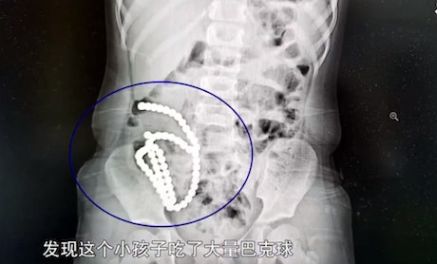 女童照X光惊见长串白点　医生摇头：一辈子毁了
