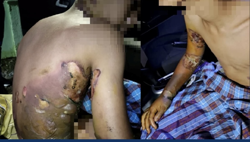 9岁童在家烧蛋壳驱蚊被烧伤没送院,父母遭友人举报