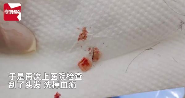 打篮球撞头 一周后头顶飘腐臭味就医惊悉头皮卡两颗牙