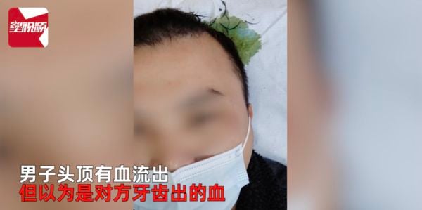 打篮球撞头 一周后头顶飘腐臭味就医惊悉头皮卡两颗牙