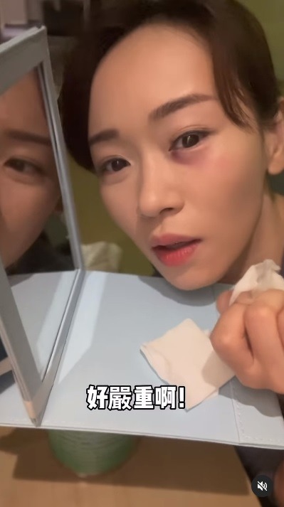 杨思琦“被掳”遭枪插眼 差1毫米就瞎！