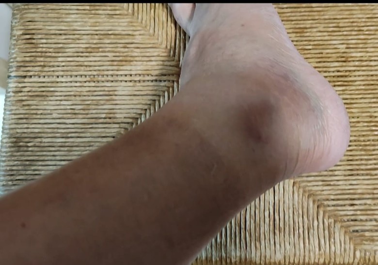 林敏骢脚伤预告缺席TVB颁奖礼 网猜:没奖拿?