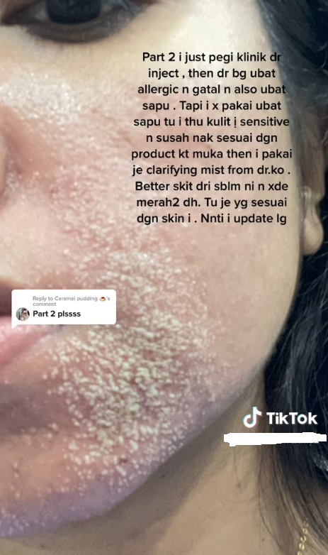 逛二手服装店隔日脸肿脱皮 女子:“我也毛骨悚然”