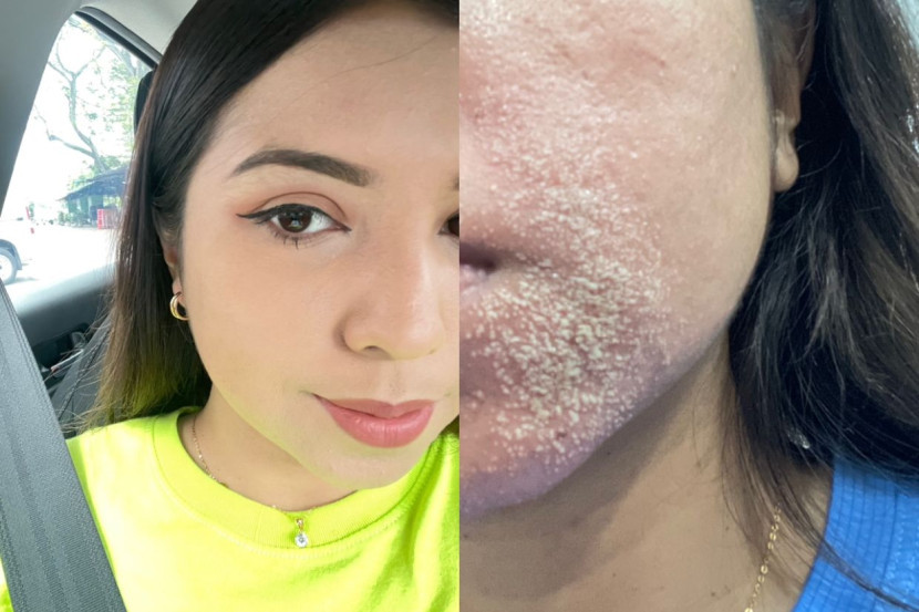 逛二手服装店隔日脸肿脱皮 女子:“我也毛骨悚然”