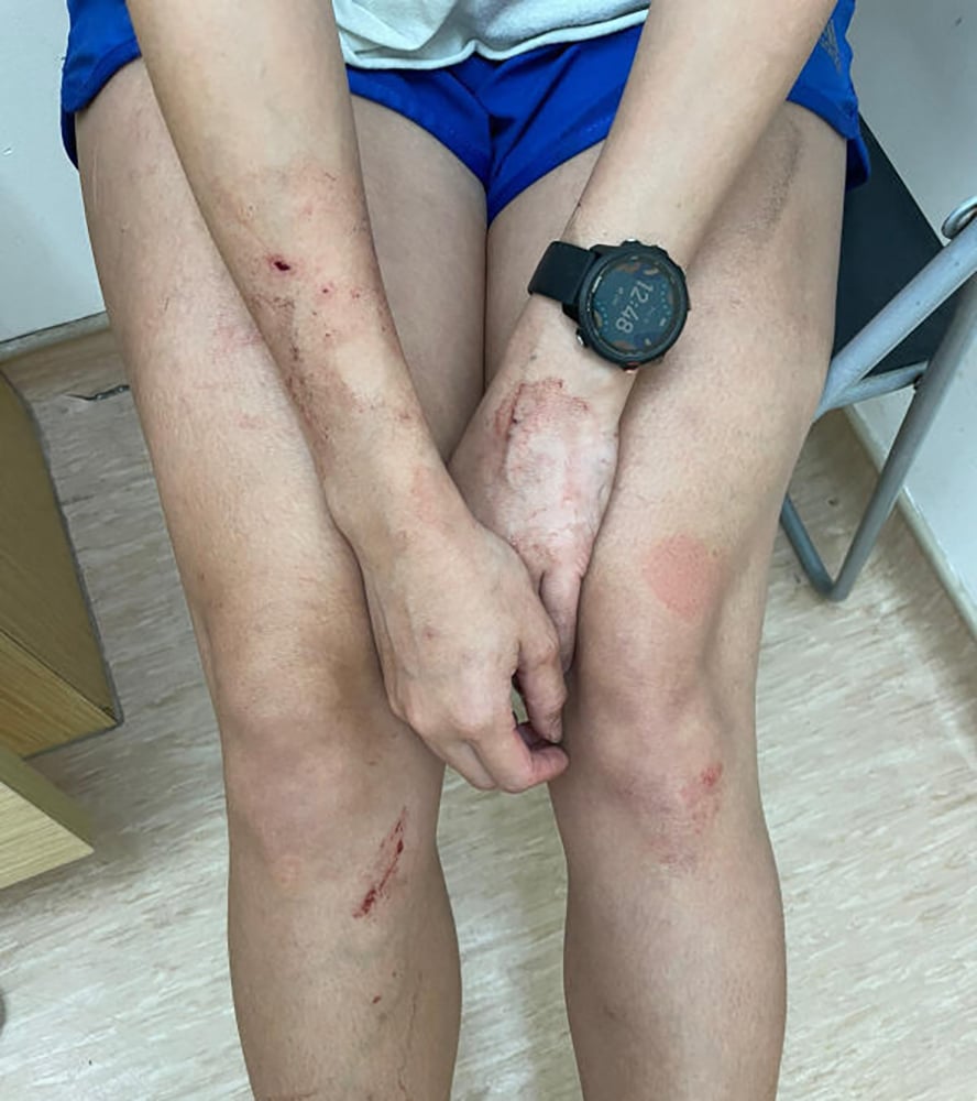 (已签发)柔:狮城二三事:宝马撞倒遛狗女 爱犬被碾拖50公尺