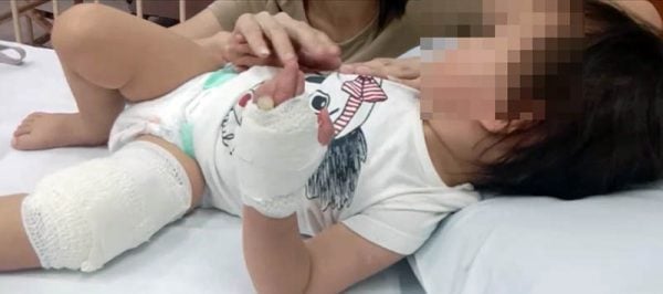 女童左腿被山豬咬傷,需要縫針。(圖:黃耀輝提供)