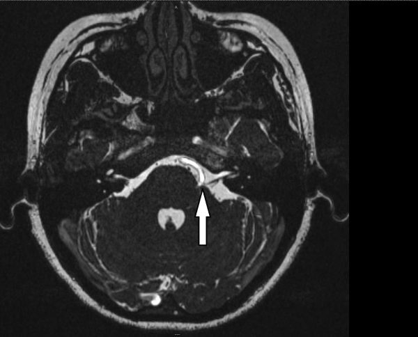 脑干血管膨胀弯曲，压迫左边颜面神经线的出口处，造成神经线受压（箭头处）。