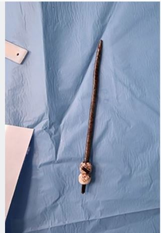 6岁女童跌倒遭「17公分发簪」由口腔刺穿后脑 术后奇迹取出