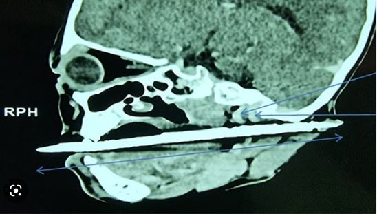 6岁女童跌倒遭「17公分发簪」由口腔刺穿后脑 术后奇迹取出