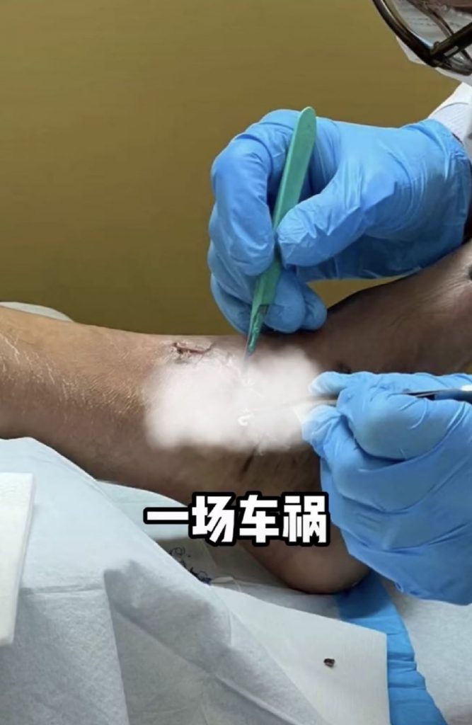 ​陈学冬出严重车祸  左腿肌肉萎缩坐轮椅