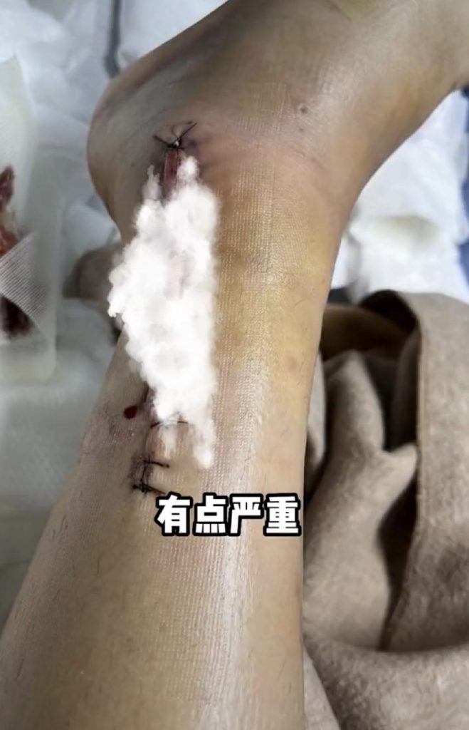 ​陈学冬出严重车祸  左腿肌肉萎缩坐轮椅