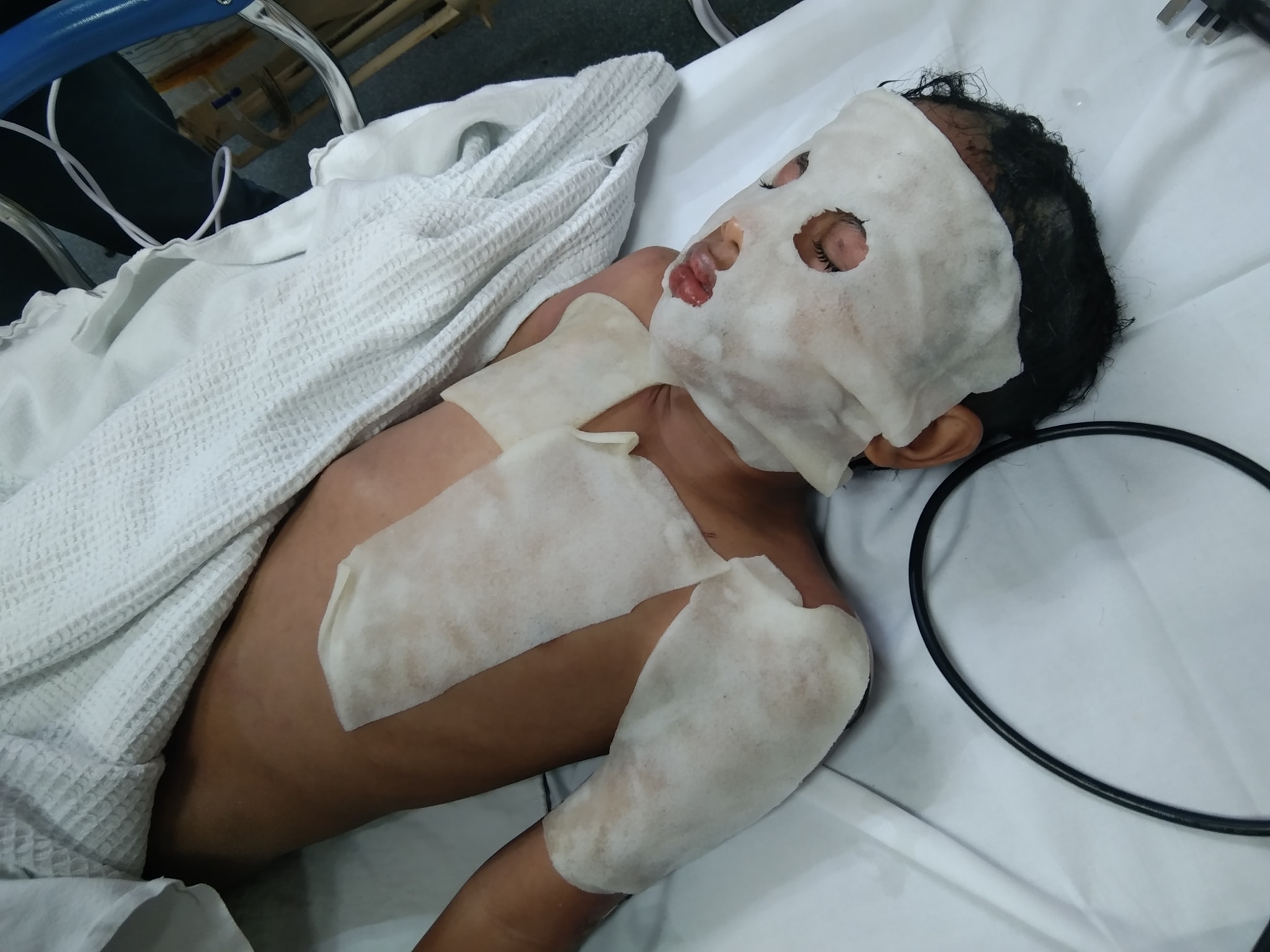 以小苏打粉通水管引发爆炸,一对小兄妹被灼伤