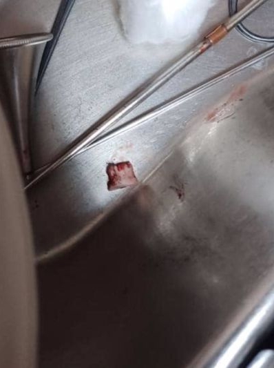 女童将橡皮檫塞进耳洞!耳壁出血 诊所医生试了2次都取不出