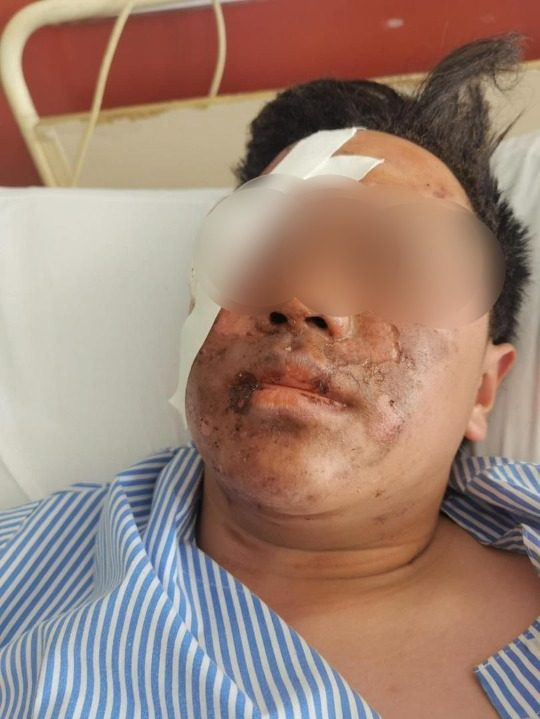 **已签发**国：★独家：舞狮时点烟花却酿爆炸，18岁狮尾右眼失明脸部灼伤