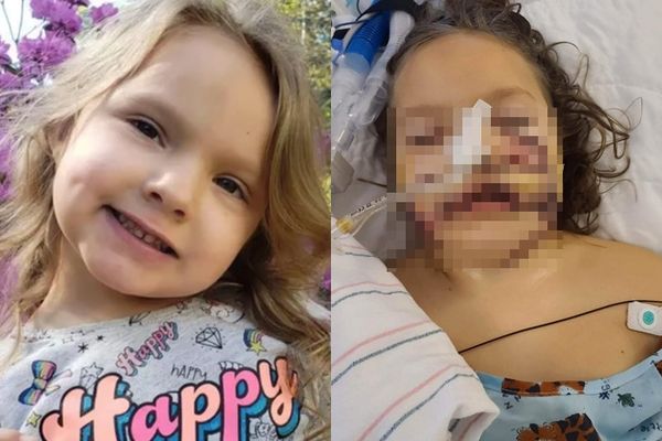 拼盘/女童被比特犬叼嘴里撕咬!脸肌肉损毁缝1000针 医:此生无法再笑