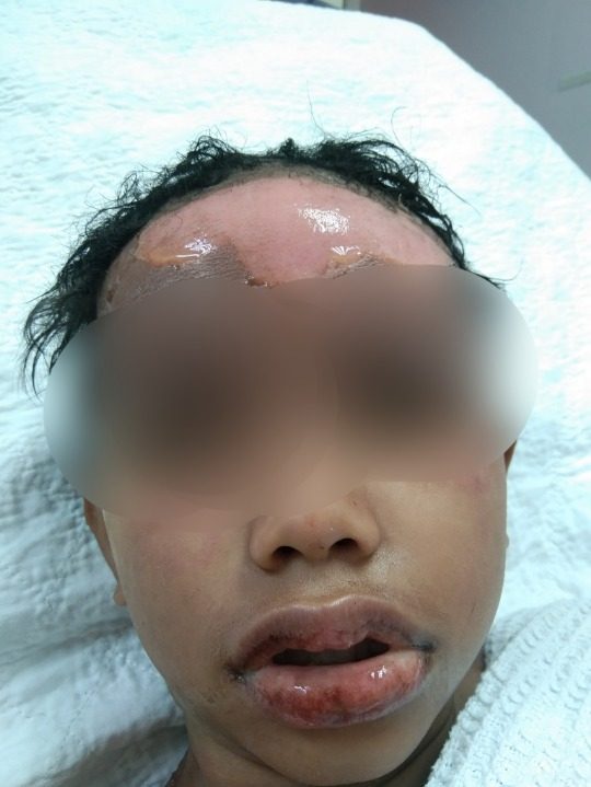 火碱通水管引爆炸|指肇事男施压求销案 伤者母亲不妥协:“我要为孩子讨回公道”