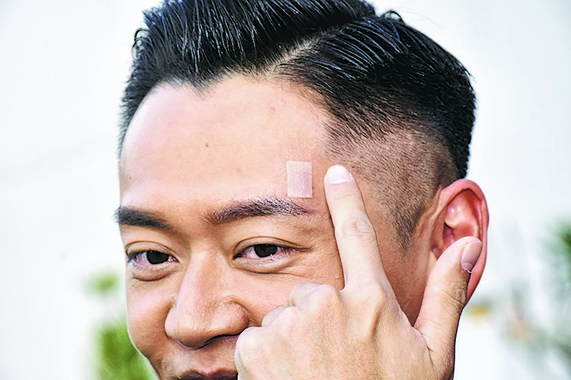 自侃甩地狱黑仔王称号 张振朗爆眉骨无惧留疤